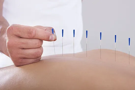 Dry Needling / Acupuncture session at Archway Wellness Centre